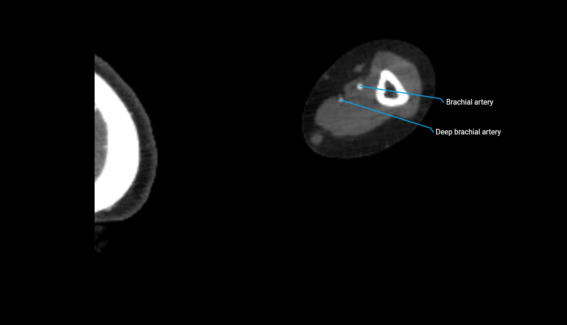 CTA upper limb axial cross sectional anatomy labelled image 212 (2).webp